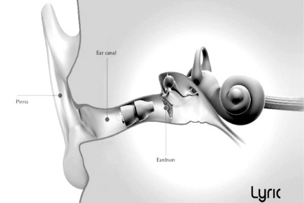 Appareil auditif invisible : l’insertion profonde dans le conduit auditif est un vrai plus !